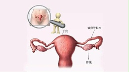 水蛭有利水道、破积聚之功，可用于治疗输卵管积水