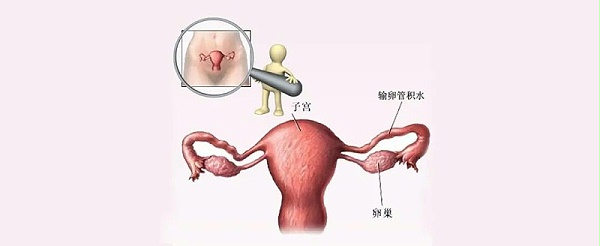 水蛭素、输卵管积水、不孕不育