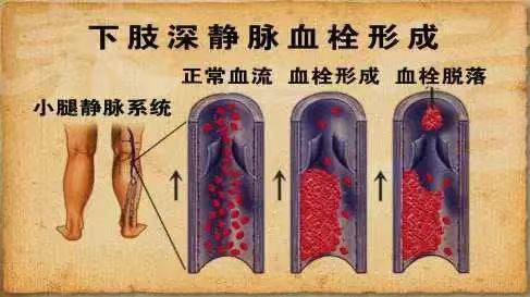 水蛭素、水蛭素胶囊、壮医水蛭疗法