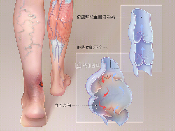 壮医水蛭疗法,天然水蛭素胶囊