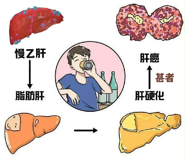 水蛭素、肝硬化、脂肪肝