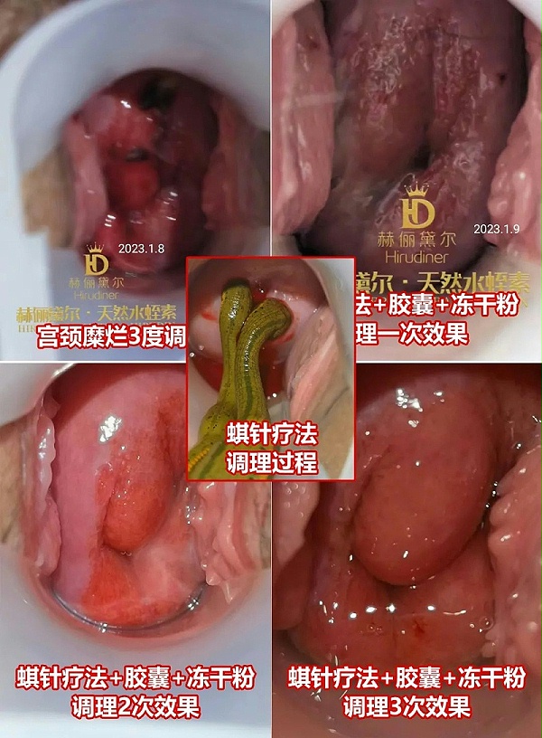 水蛭素、水蛭素胶囊、生殖妇科