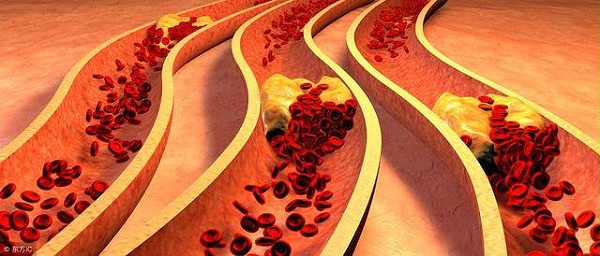 血管硬化是如何形成的