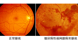 糖尿病性视网膜病变严重可致盲，水蛭或可延缓疾病进展