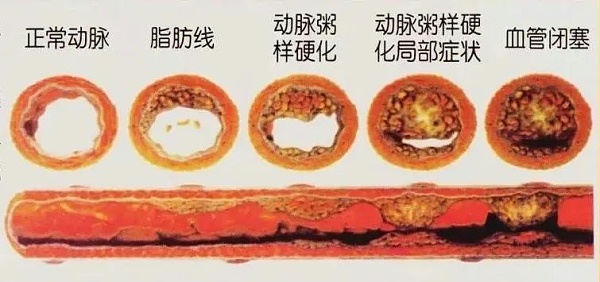 水蛭素、动脉粥样硬化、高血压