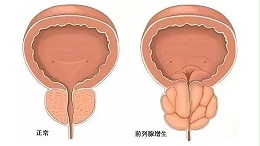 水蛭在改善前列腺增生临床症状、提高生活质量方面发挥重要作用